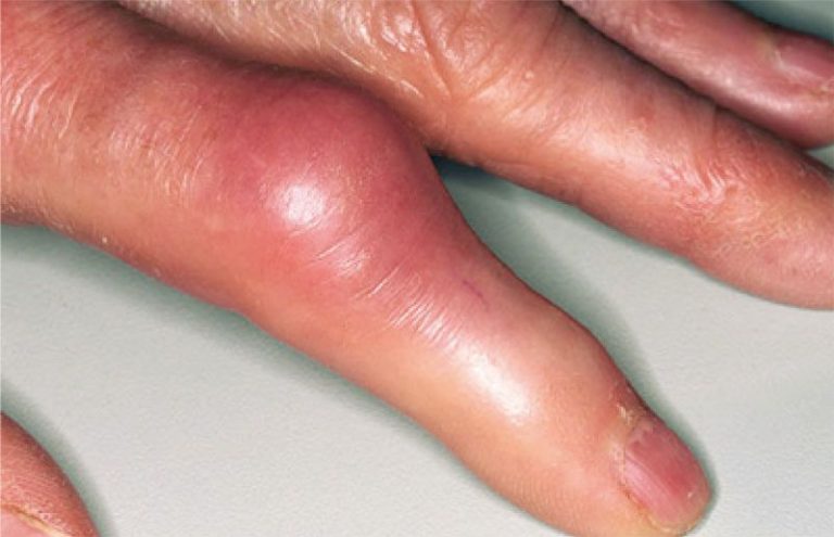 ochorenia kĺbov na ruke